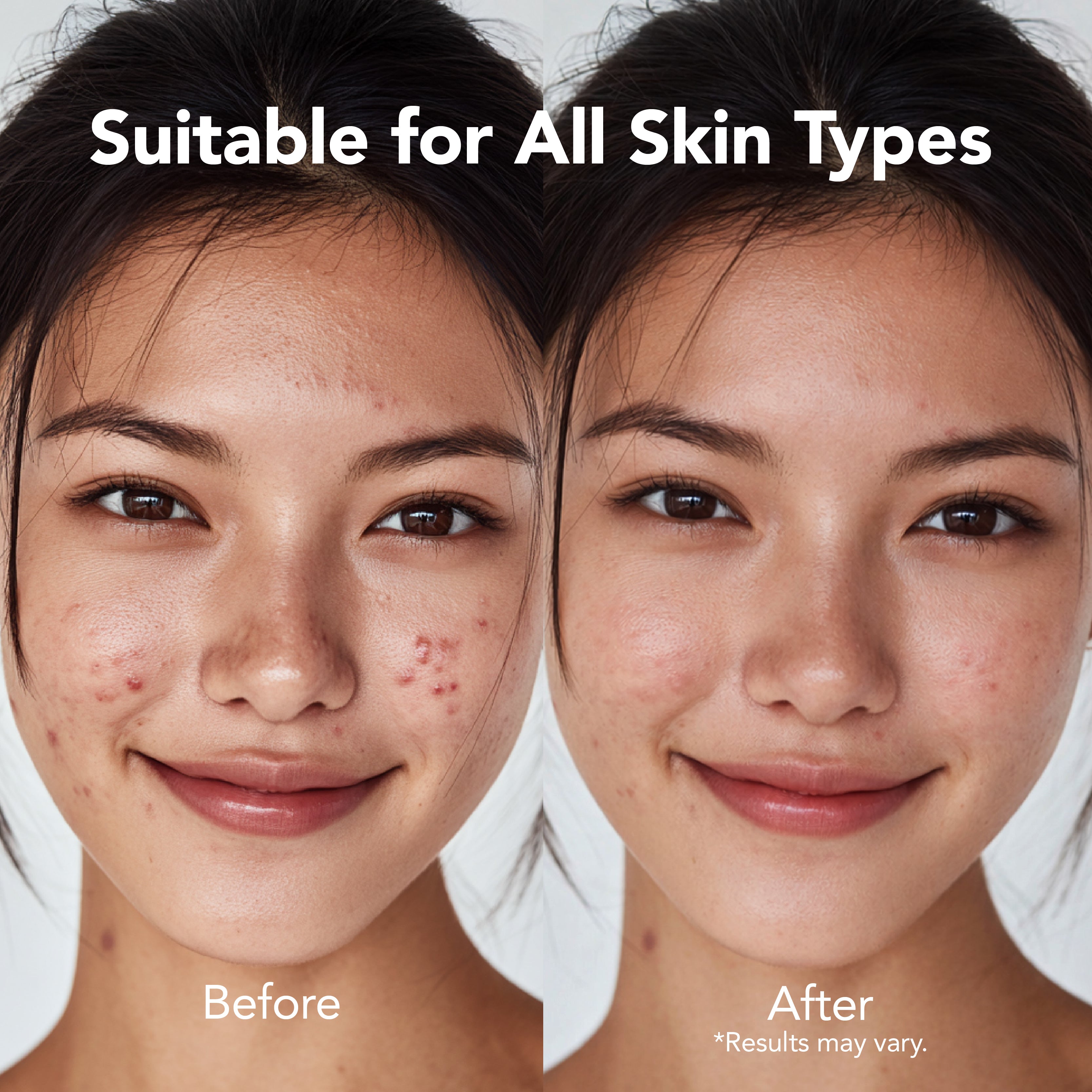Saplaya - Hydrocolloid ★Star ♥Heart Acne Patch