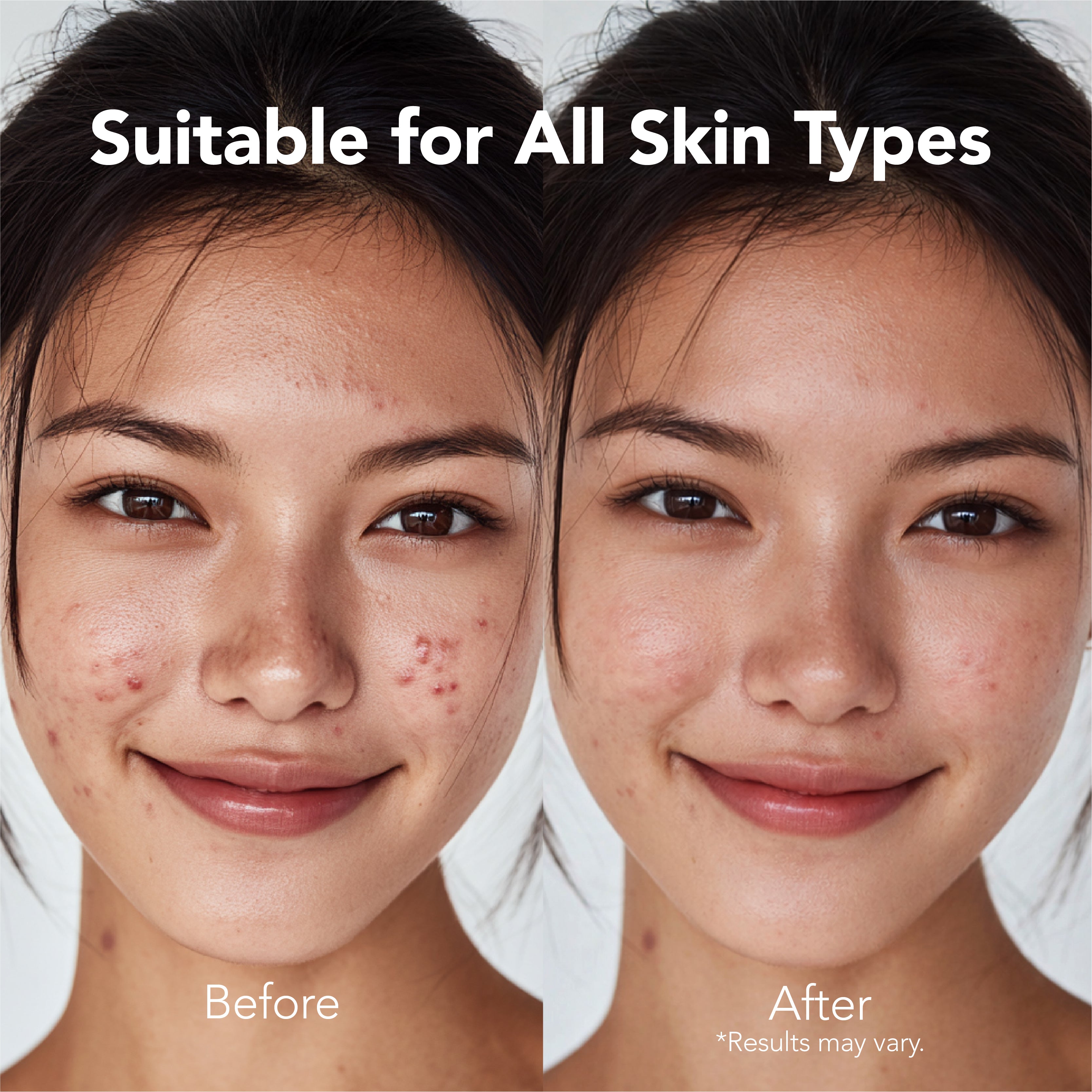 Saplaya - Acne Spot Healing Patch